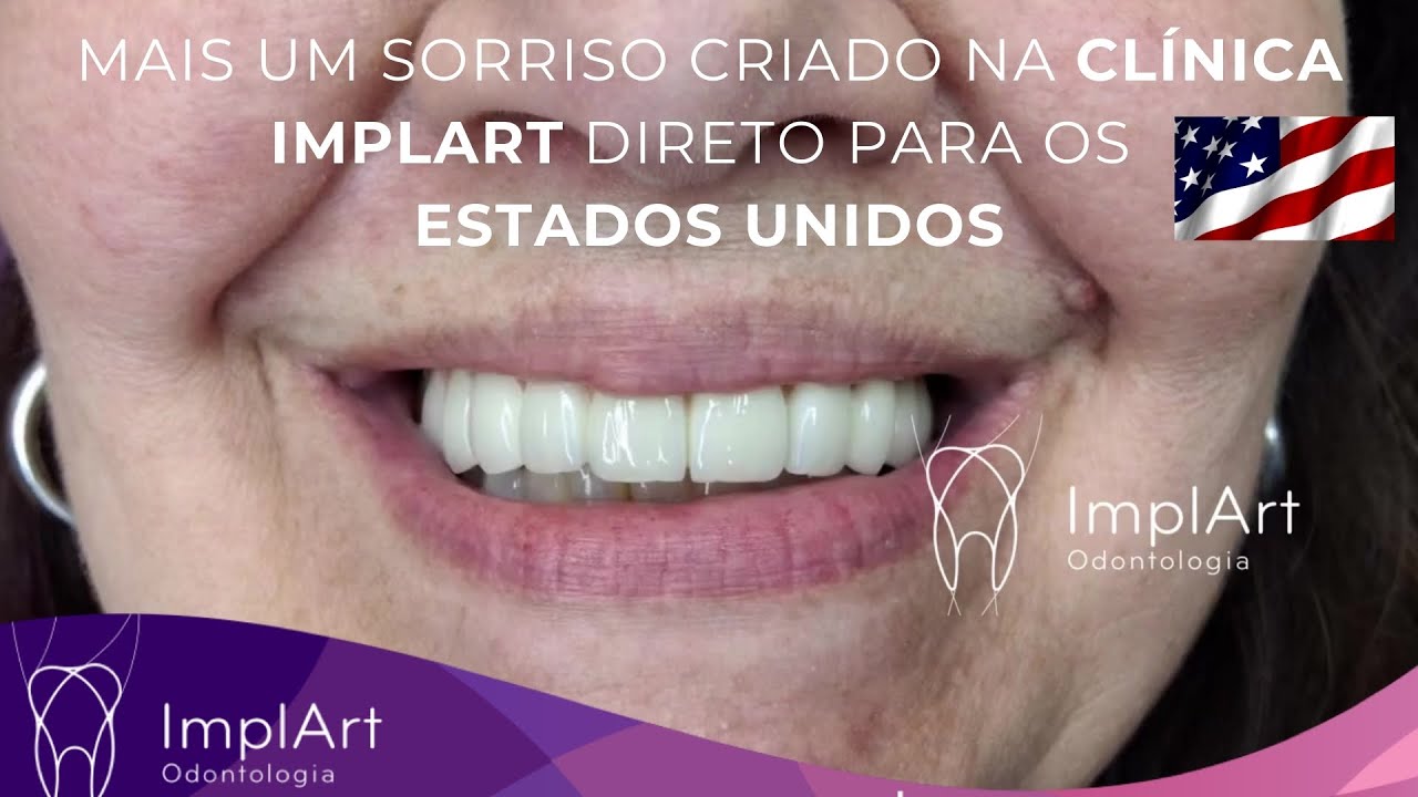 implantes dentarios all on four