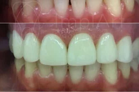 Lente contato dental antes e depois 47 edited