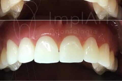 Lente contato dental antes e depois 49 edited