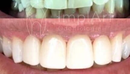 lente contato dental antes e depois 44kb edited