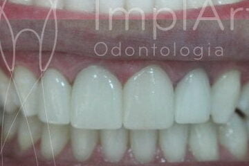 lente contato dental antes e depois 48 edited