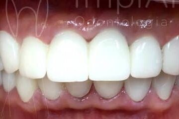 lente contato dental antes e depois 50kb edited