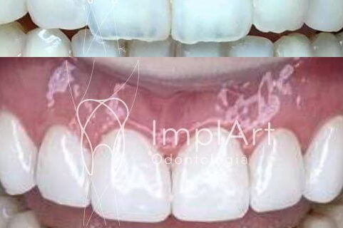 lente contato dental e gengivectomia 50kb edited