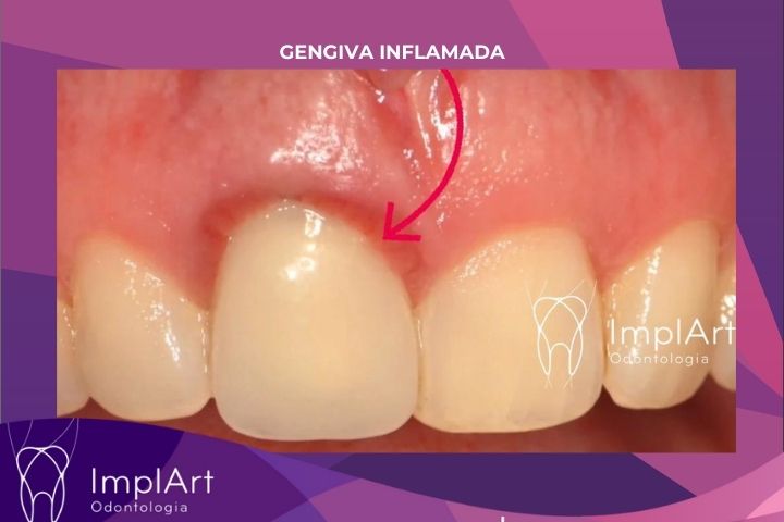 inflamed gums