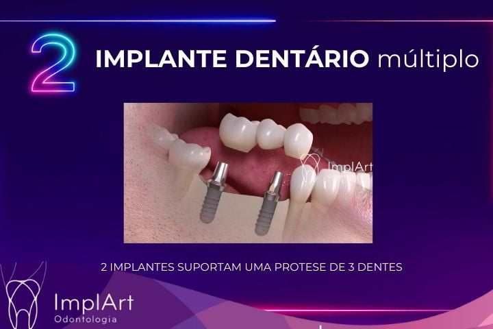 IMPLANTE DENTARIO MULTIPLO na Clinica ImplArt melhor clinica de implante dentario em São Paulo