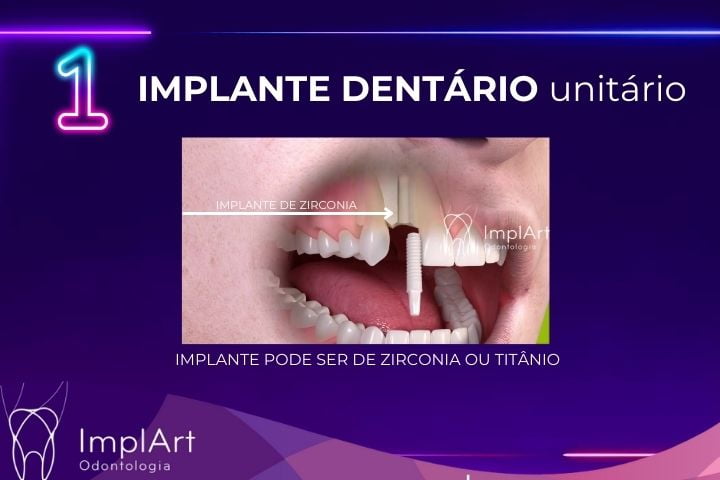 IMPLANTE DENTARIO UNITARIO na Clinica ImplArt melhor clinica de implante dentario em São Paulo