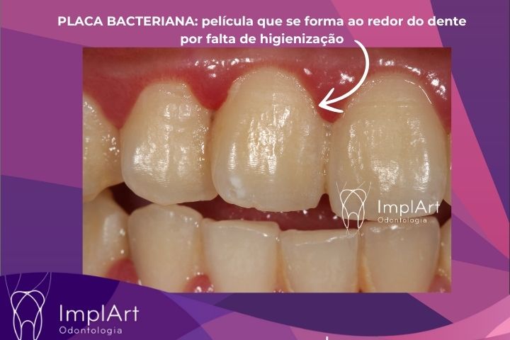 PLACA BACTERIANA