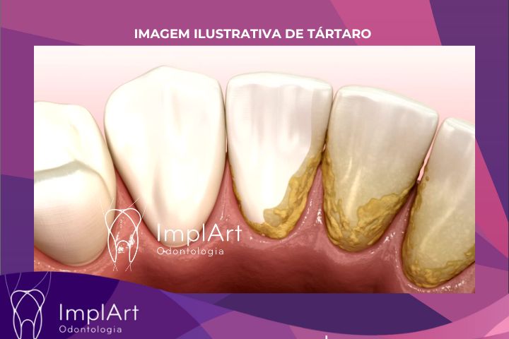 TÁRTARO - COMO EVITAR A PERDA DENTARIA E IMPLANTES COM USO DE FIO DENTAL