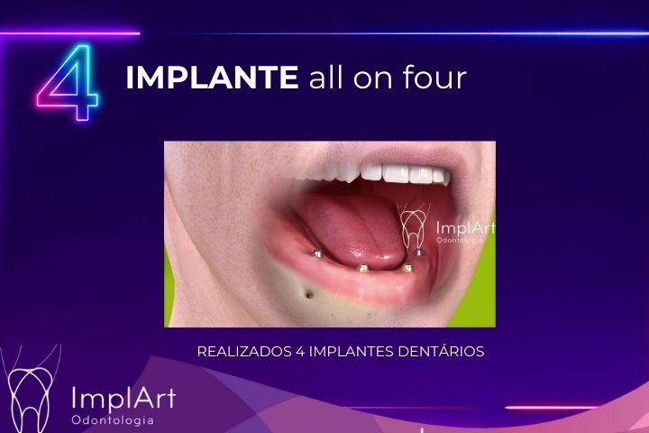 implante all on four na Clinica ImplArt melhor clinica de implante dentario em São Paulo