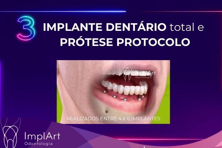 Implante total e protese protocolo na Clinica ImplArt melhor clinica de implante dentario em São Paulo