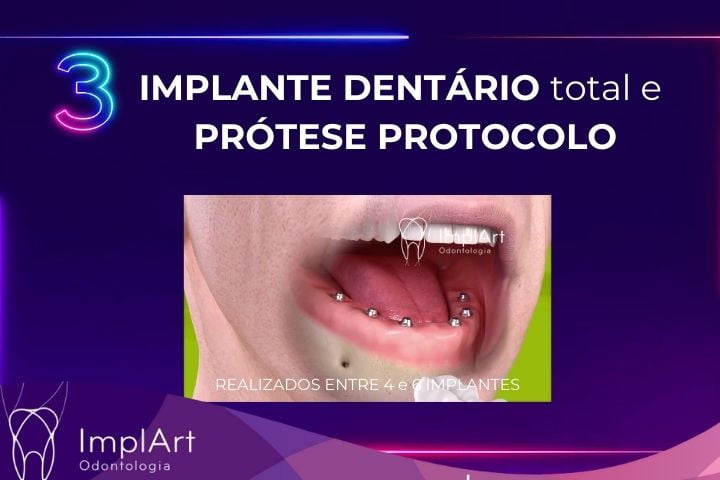 implante dentario total prótese protocolo