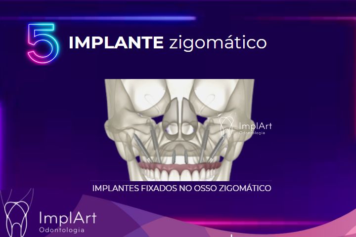 implante zigomático na clínica implart melhor clinica de implante dentario em São Paulo