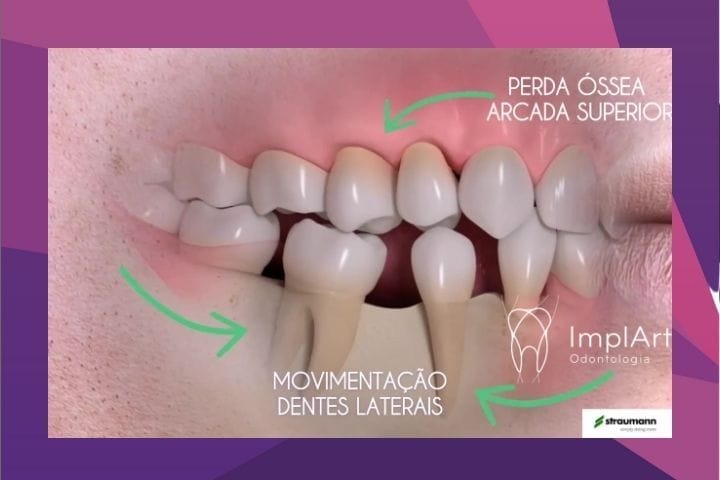 implantes dentários e perda óssea efeitos da ausencia dental