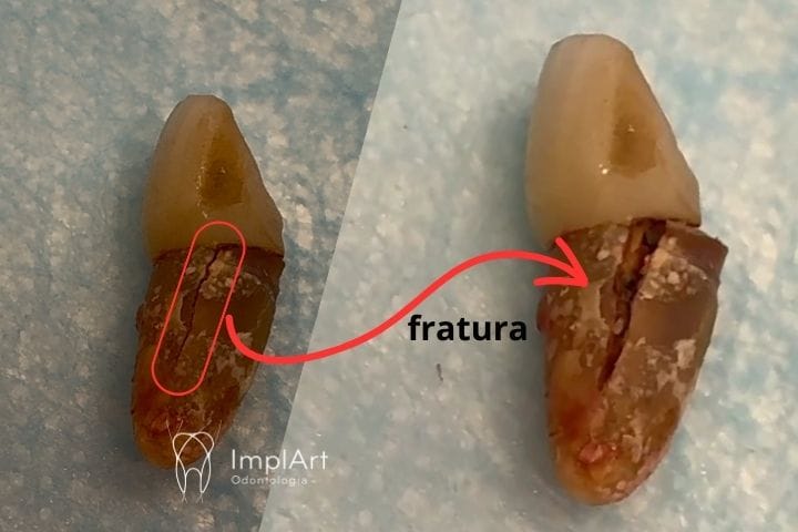 tratamento de canal ou implante dentario