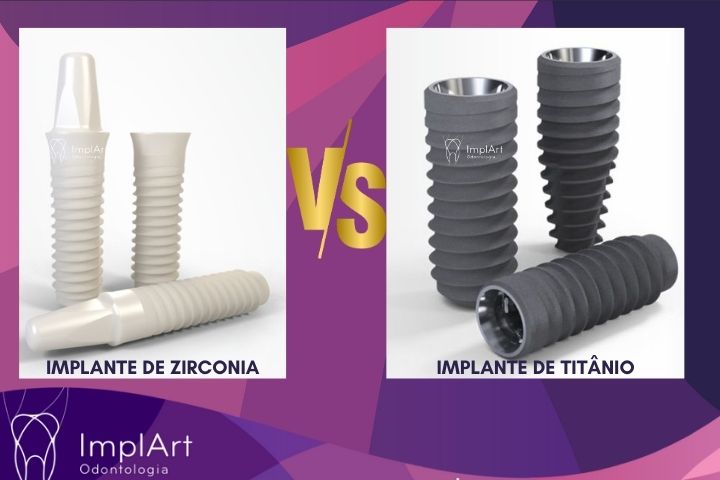 cirurgia de implantes dentarios QUAL MELHOR IMPLANTE