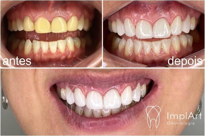 Dental contact veneers