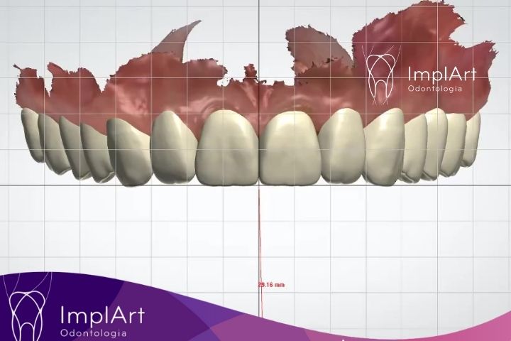 IMPLANTE DENTARIO COM PLANEJAMENTO DIGITAL 