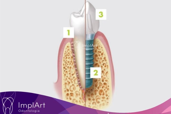 implante dentario e dente natural