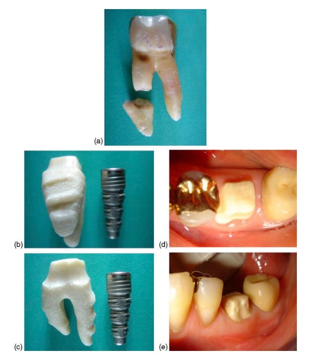 root analog implant