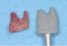 custom implant roor analog implant