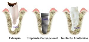 root analog implant 5