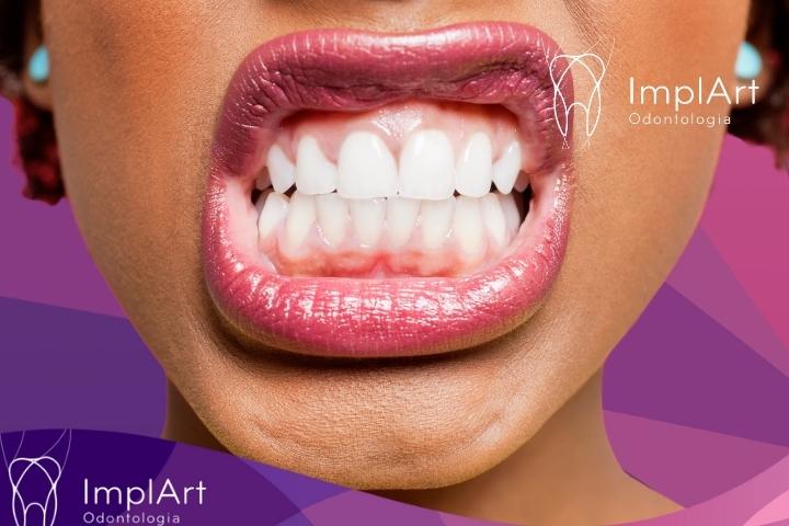 bruxism and clenching