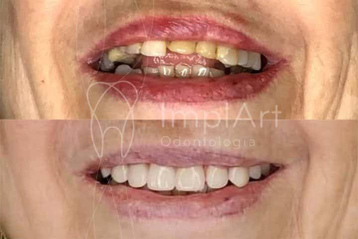 Replacing teeth with periodontal disease with implants Tooth replacement