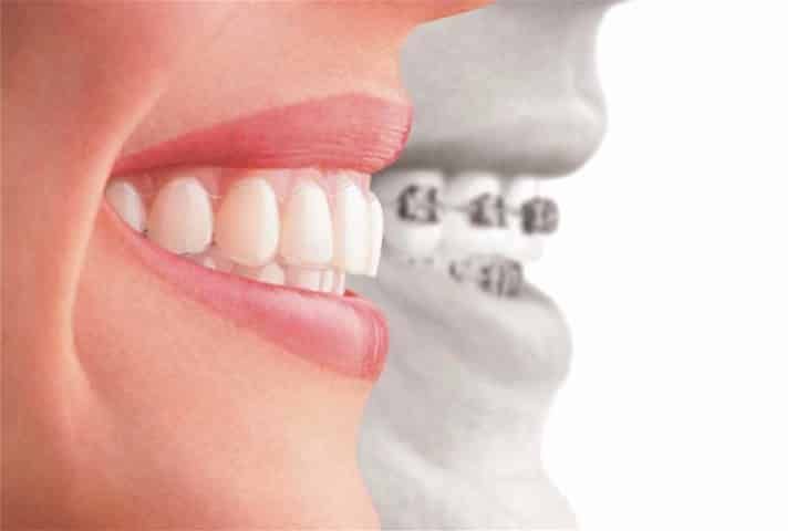 Transparent aligner - braces without parts glued to the teeth aligner