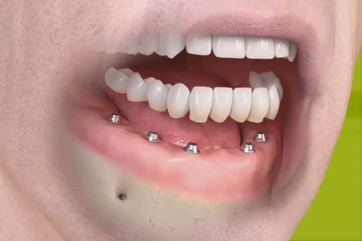 Full Arch implants: 11 stages of treatment full arch