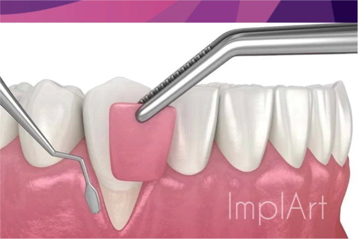 Gum grafting to improve the aesthetics of teeth Gingival grafting