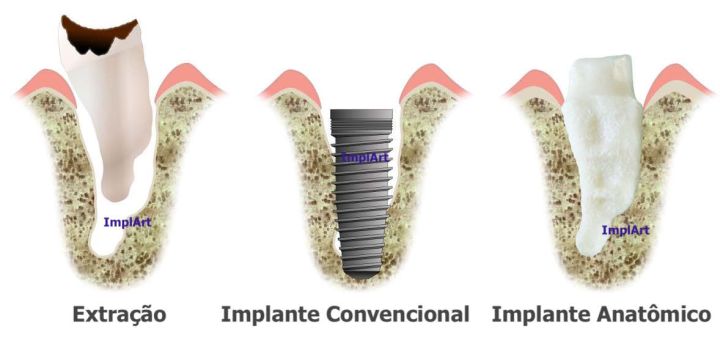 Root Implant Analog (RIA): Concepts, Benefits and Scientific Evidence root analog implant 5