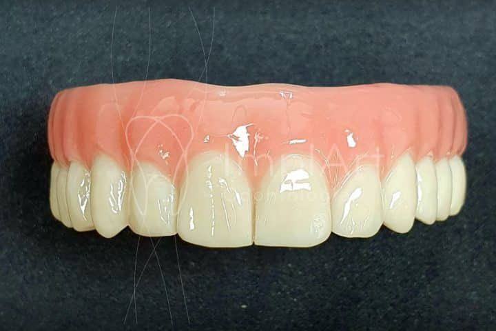 Dental prosthesis price in Brazil protese protocolo