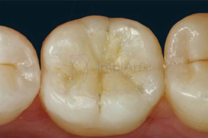 Onlays em resina Onlays em resina