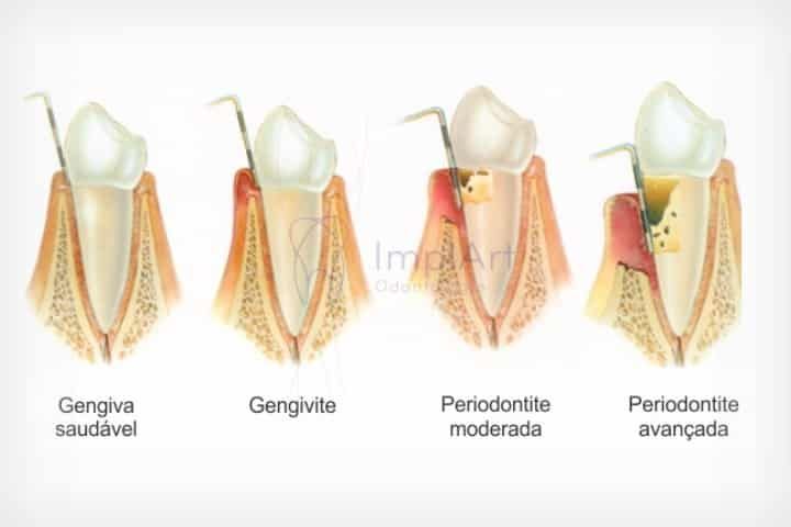 Doença periodontal - causas periodontal