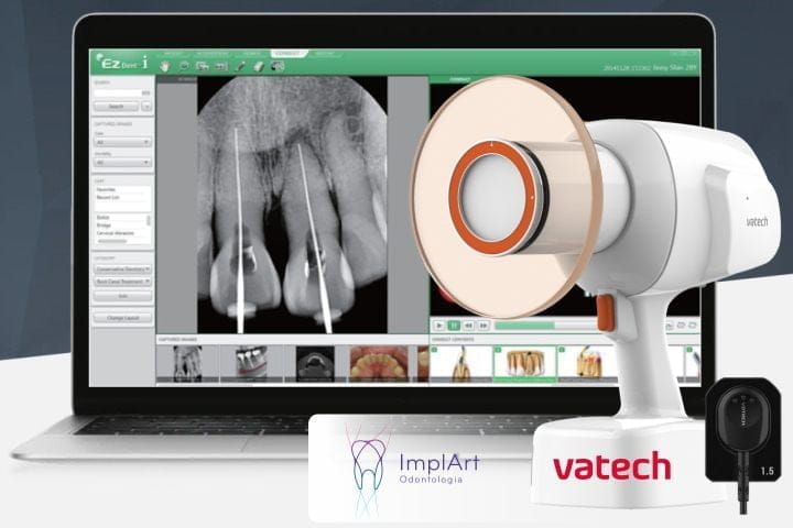 Digital Periapical Radiography at ImplArt digital periapical radiography