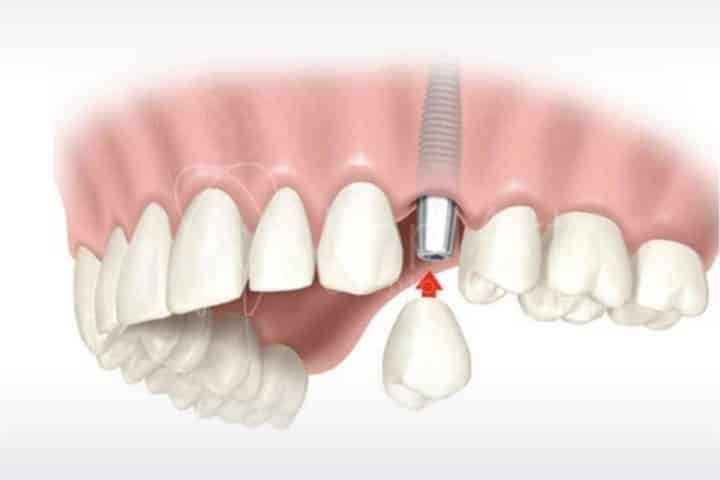 Rapid immediate loading of dental implants Immediate loading=