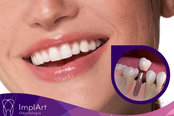 Single Tooth Dental Implant implante dentario individual