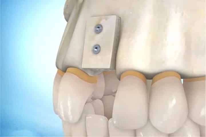 Will I lose my dentures during dental bone grafting? enxerto em bloco