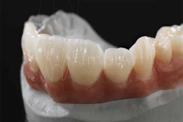 Fixed prosthesis on teeth can be replaced by crowns and implants dental prosthesis