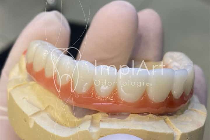 Zirconia prosthesis for dental implants Zirconia prosthesis