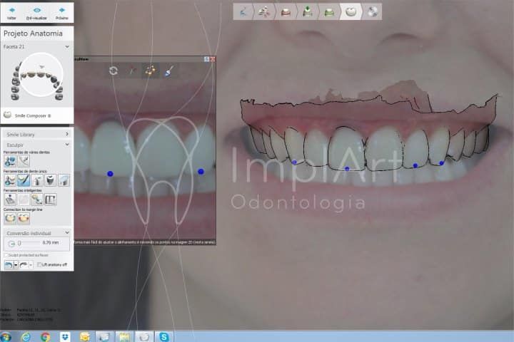 Computerized dental aesthetics - Digital Pre-treatment planning Computerized dental aesthetics