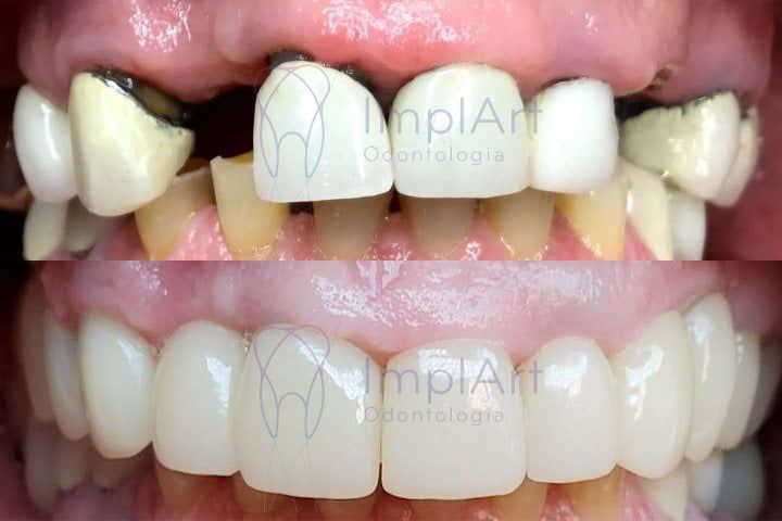 Implant all your teeth individually one-by-one with confidence individual teeth