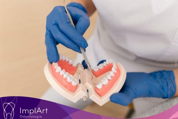 Implante dentário: tipos de implante dentario e etapas de tratamento tipos de implatne dentario