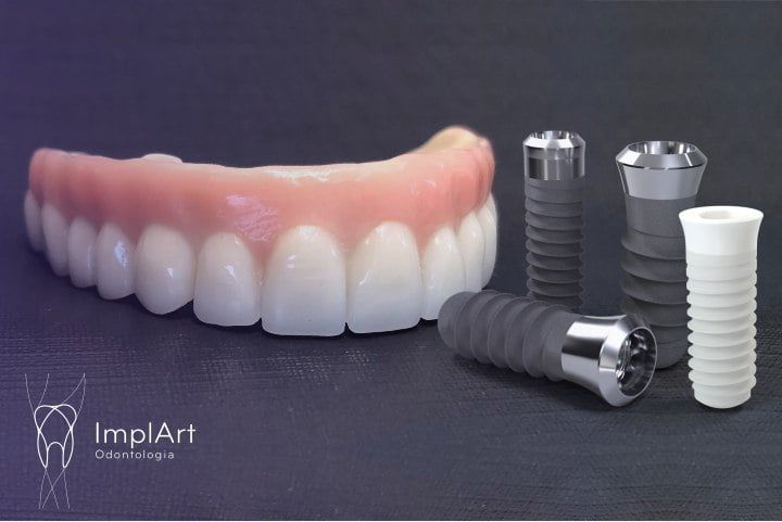 Implante Dentario na ImplArt Clínica odontológica Especialista em Implantes Dentários clinica especialista