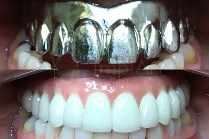 Coroas e próteses em metalocerâmica - porcelana tradicional metalocerâmica