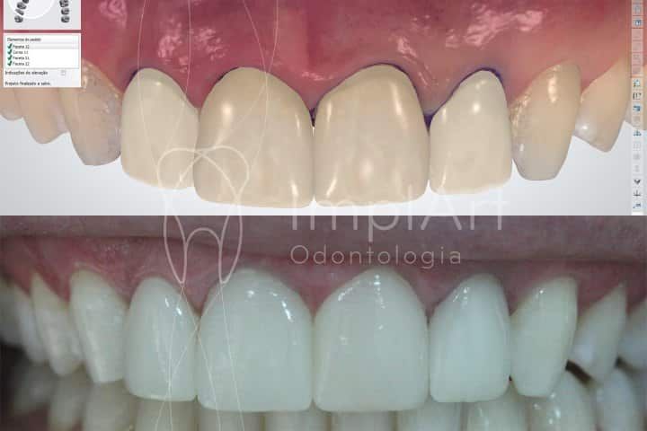 Dental contact lenses - Day Clinic Dental contact lenses