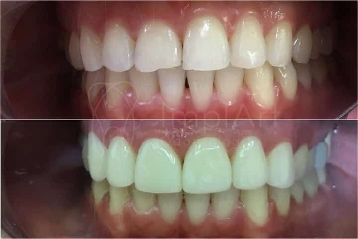 Dental contact lenses - Dental Porcelain Veneers aesthetic dental