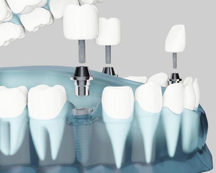 Implanting several teeth at the same time implante de varios dentes