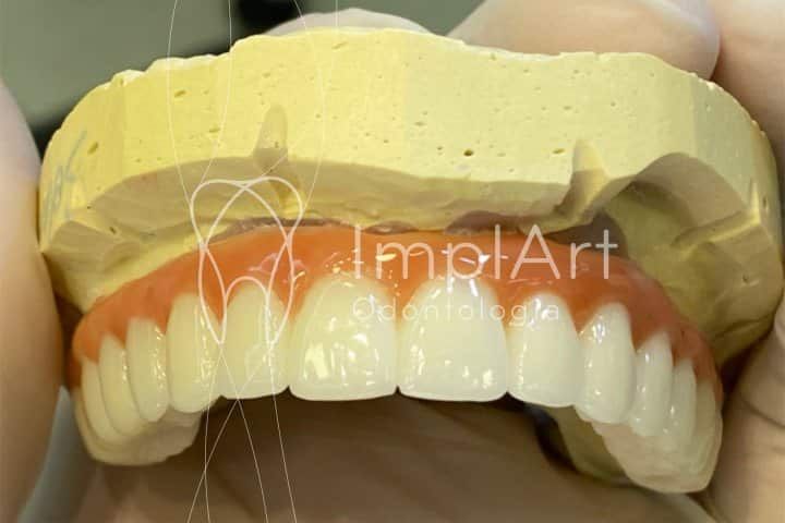 Prótese protocolo com implantes - tipos de materiais Prótese protocolo com implantes