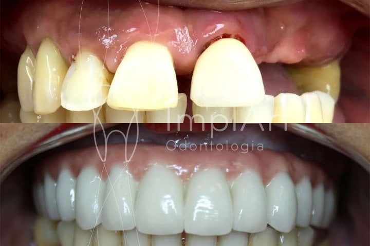 Complete dental implants improve chewing, self-esteem and aesthetics Complete dental implant